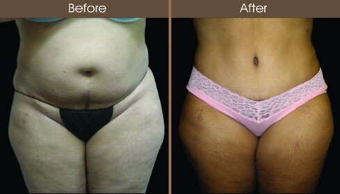 20122210155413_abdom_8_front